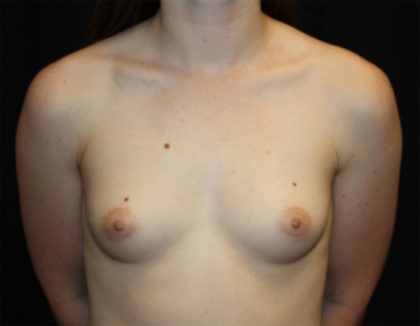 Breast Augmentation - Shaped Silicone Implants Before & After Patient #20453