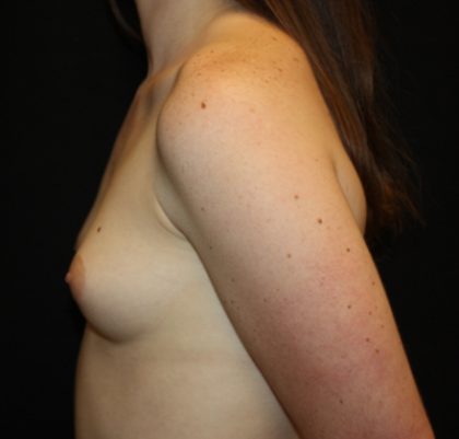 Breast Augmentation - Shaped Silicone Implants Before & After Patient #20453