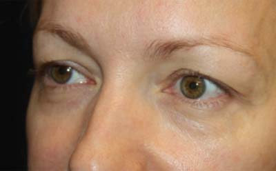 Blepharoplasty Before & After Patient #24828