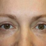 Blepharoplasty Before & After Patient #24828