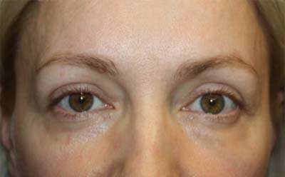 Blepharoplasty Before & After Patient #24828