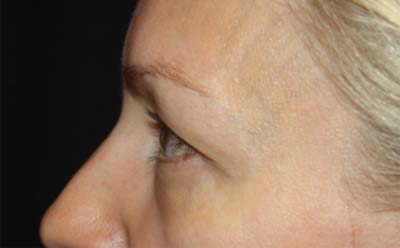 Blepharoplasty Before & After Patient #24828