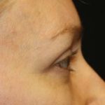 Blepharoplasty Before & After Patient #24828