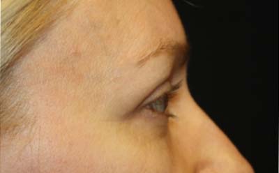 Blepharoplasty Before & After Patient #24828