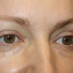 Blepharoplasty Before & After Patient #24828