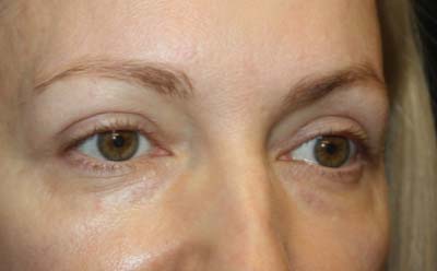 Blepharoplasty Before & After Patient #24828