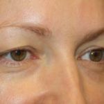 Blepharoplasty Before & After Patient #24828