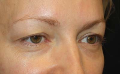 Blepharoplasty Before & After Patient #24828
