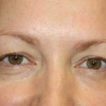 Blepharoplasty Before & After Patient #24828