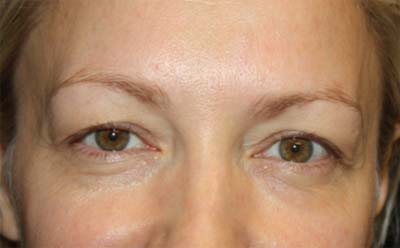 Blepharoplasty Before & After Patient #24828