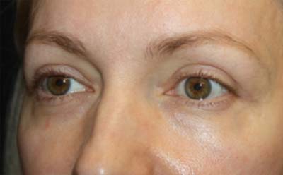 Blepharoplasty Before & After Patient #24828