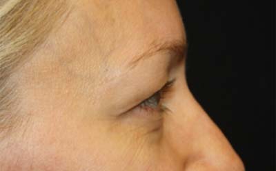 Blepharoplasty Before & After Patient #24828