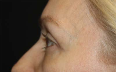 Blepharoplasty Before & After Patient #24828