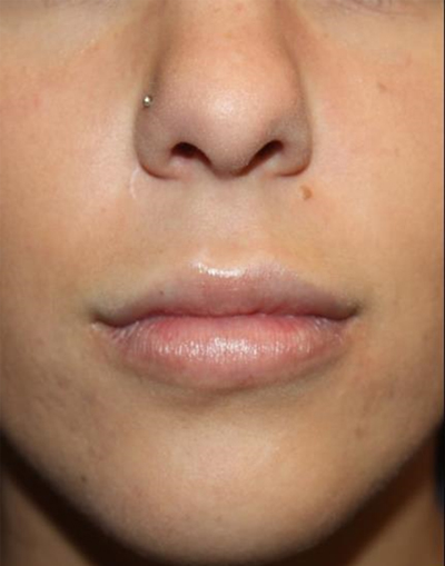 Injectable Fillers Before & After Patient #21341