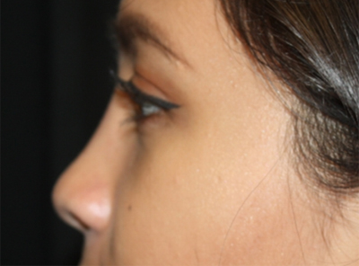 Rhinoplasty Before & After Patient #21703
