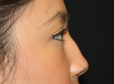 Rhinoplasty Before & After Patient #21703