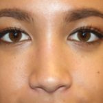Rhinoplasty Before & After Patient #21703
