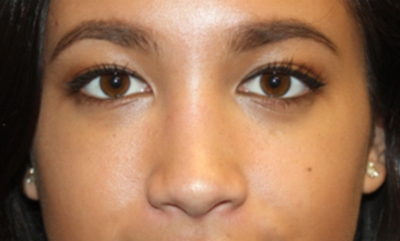 Rhinoplasty Before & After Patient #21703