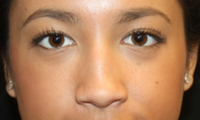 Rhinoplasty Before & After Patient #21703