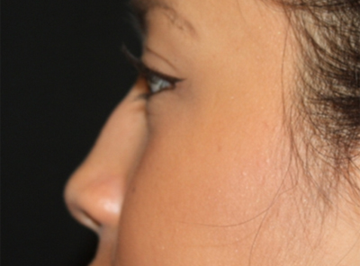 Rhinoplasty Before & After Patient #21703