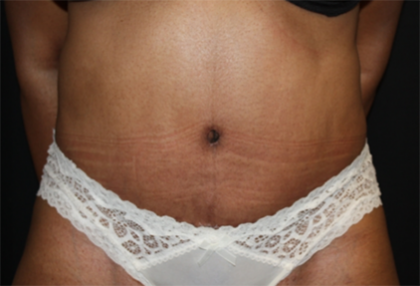 Tummy Tuck Before & After Patient #22564