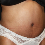 Liposuction Before & After Patient #23221