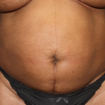 Liposuction Before & After Patient #23221