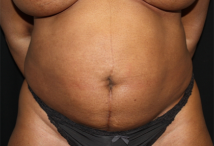 Liposuction Before & After Patient #23221