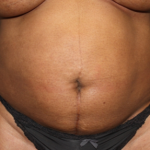 Tummy Tuck Before & After Patient #22564