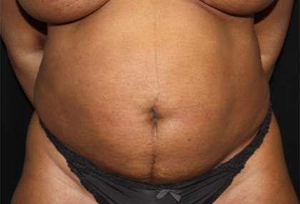 Tummy Tuck Before & After Patient #22564