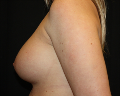 Breast Augmentation - Shaped Silicone Implants Before & After Patient #20474