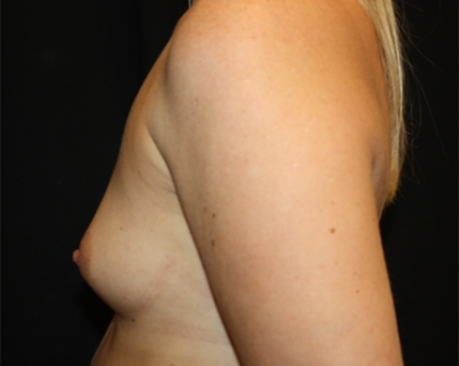 Breast Augmentation - Shaped Silicone Implants Before & After Patient #20474