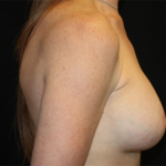 Breast Augmentation - Shaped Silicone Implants Before & After Patient #20475