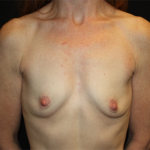 Breast Augmentation - Shaped Silicone Implants Before & After Patient #20475