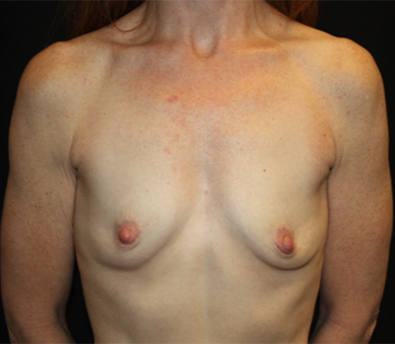 Breast Augmentation - Shaped Silicone Implants Before & After Patient #20475