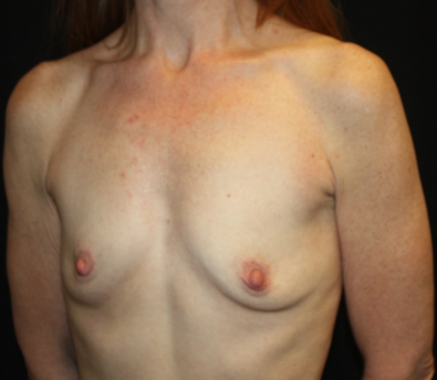 Breast Augmentation - Shaped Silicone Implants Before & After Patient #20475