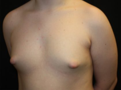 Gynecomastia Before & After Patient #21283