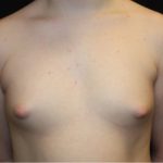 Gynecomastia Before & After Patient #21283