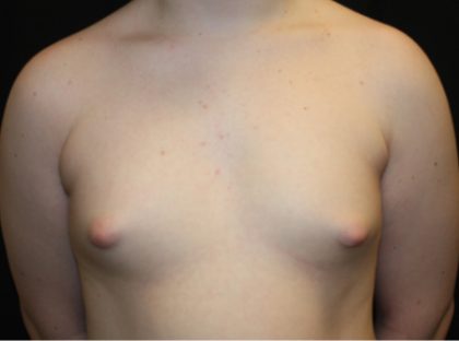 Gynecomastia Before & After Patient #21283