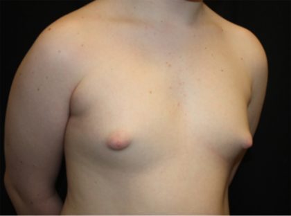 Gynecomastia Before & After Patient #21283