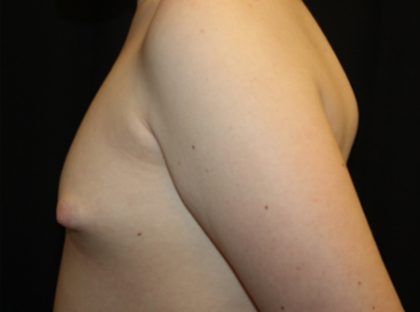 Gynecomastia Before & After Patient #21283