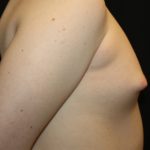 Gynecomastia Before & After Patient #21283