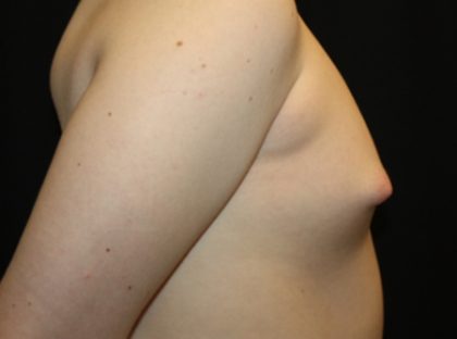 Gynecomastia Before & After Patient #21283