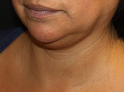 Kybella Before & After Patient #19776