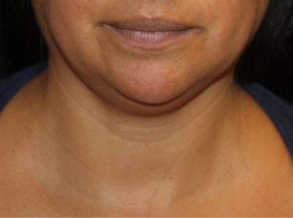 Kybella Before & After Patient #19776