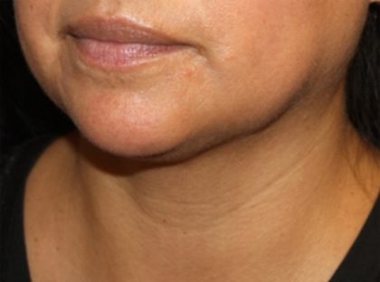 Kybella Before & After Patient #19776