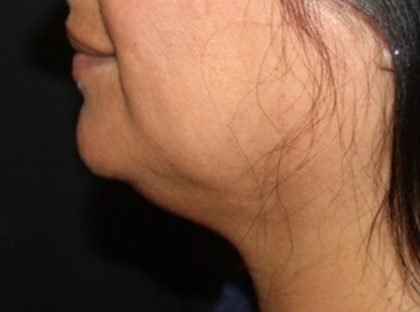 Kybella Before & After Patient #19776