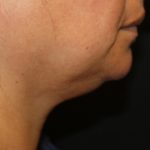 Kybella Before & After Patient #19776