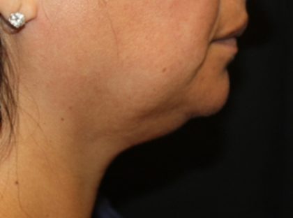 Kybella Before & After Patient #19776