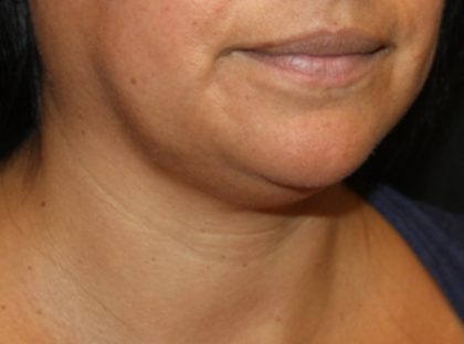 Kybella Before & After Patient #19776